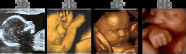 Bun in the Oven - Cutie Pie Scan - Fairbanks - Image 4